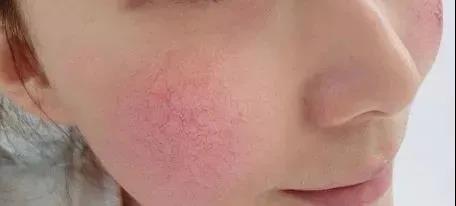 敏感肌肤