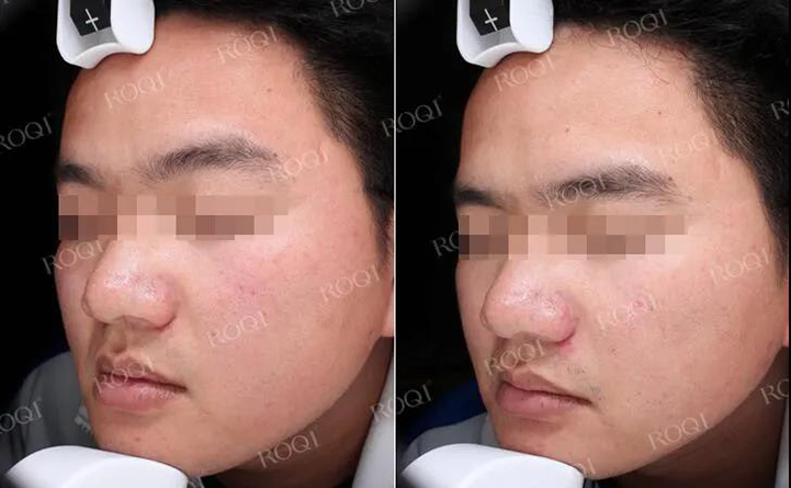 若清舒缓修护套组治疗真实案例展示