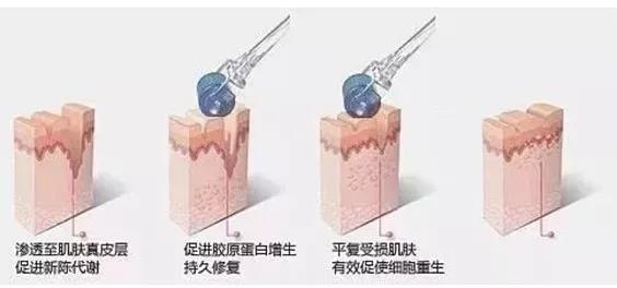 微针祛痘