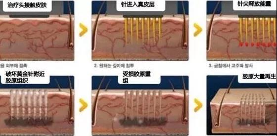 滚针针刺