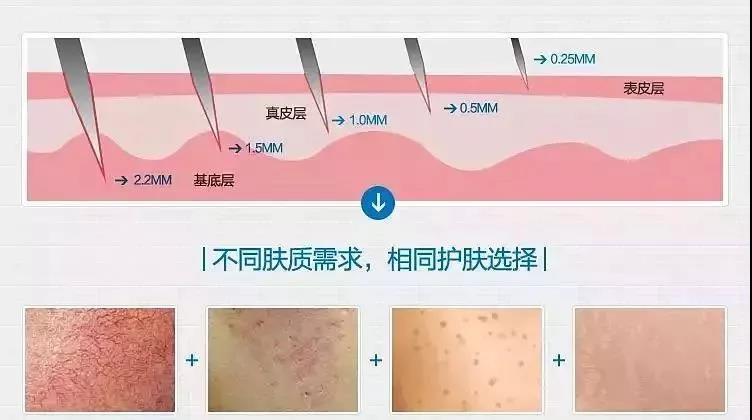 微针选择
