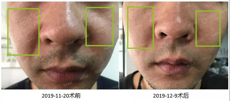若清平肌紧致修护套组术后19天