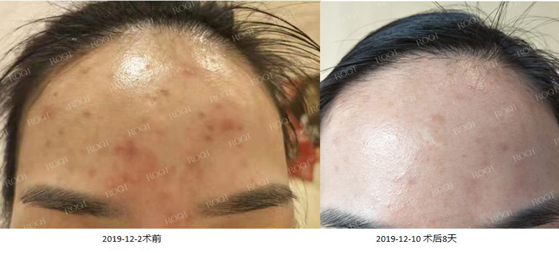 若清控油净痘修护套组术后8天