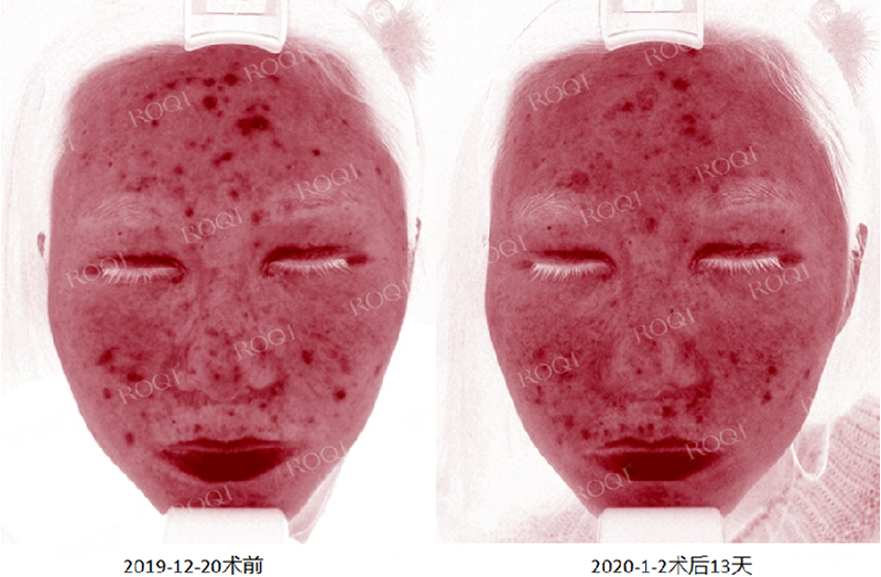 若清控油净痘修护套组术后13天