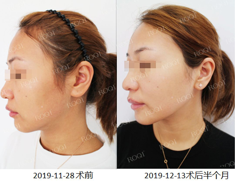 若清净颜靓肤修护套组术后15天